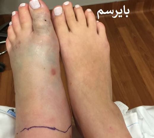 در صورت نیش مار چه باید کرد