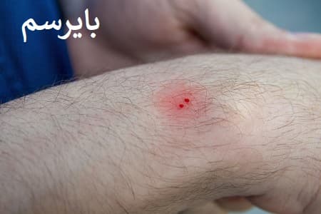 از بین بردن نیش مار
